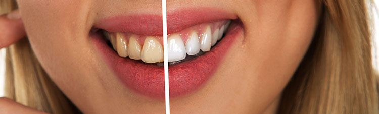 Cuál es la relación entre Gingivitis y Periodontitis-slide.jpg